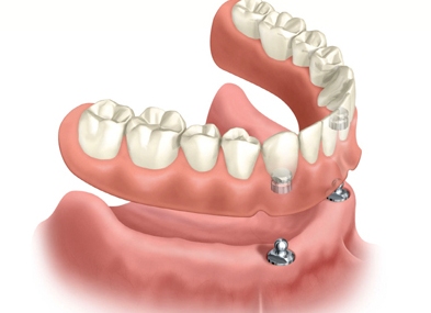 implant retained denture